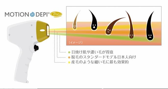 蓄熱式脱毛方式（SHR）のレーザー脱毛機